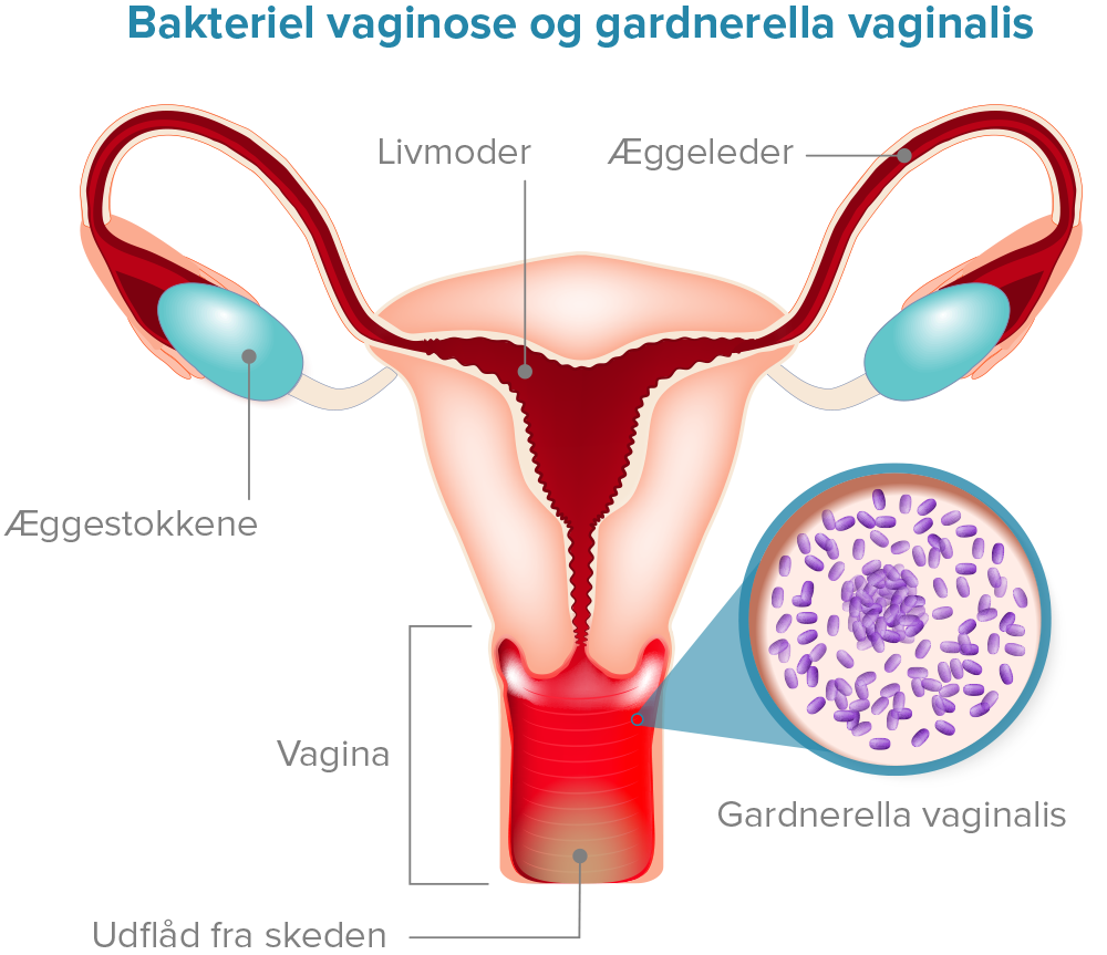Bakteriel vaginose og Gardnerella Vaginalis Diagram.