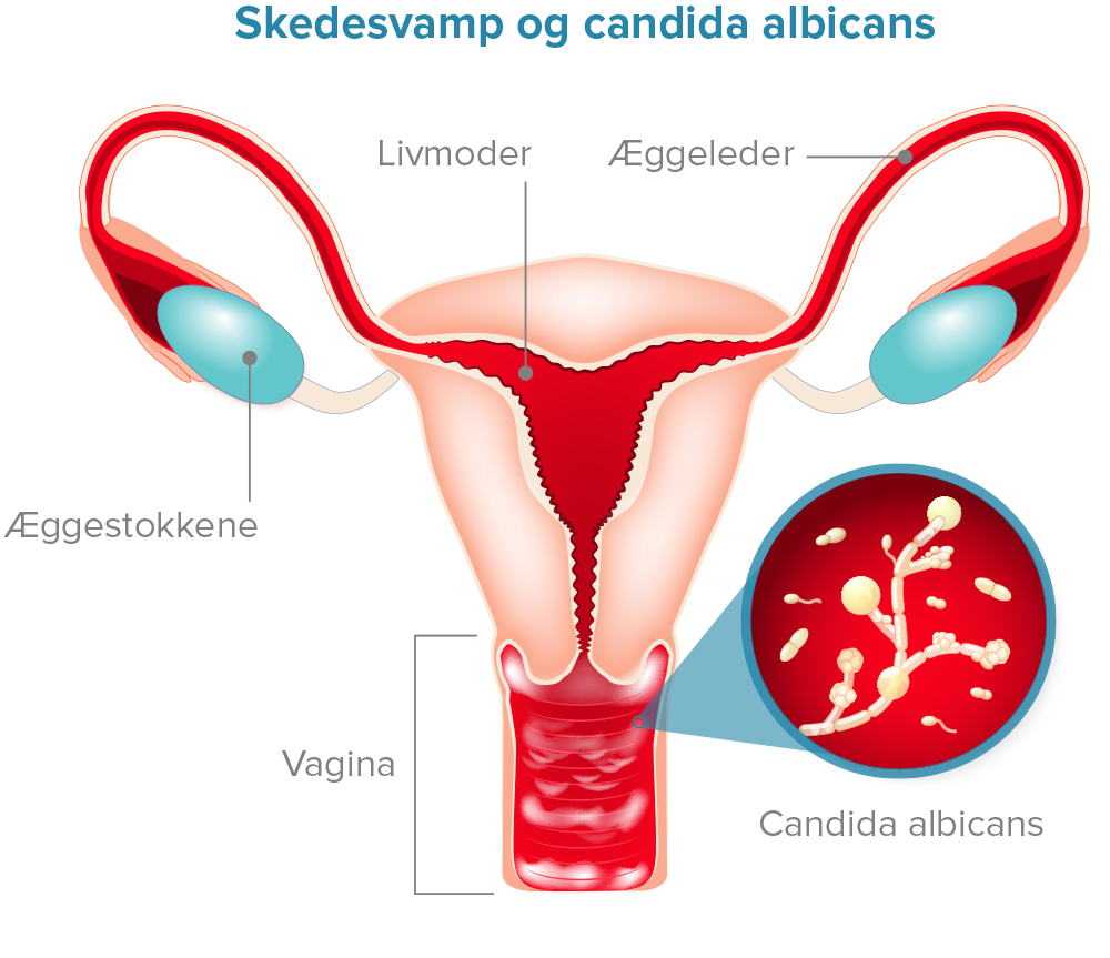 Skedesvamp og Candida albicans Diagram.